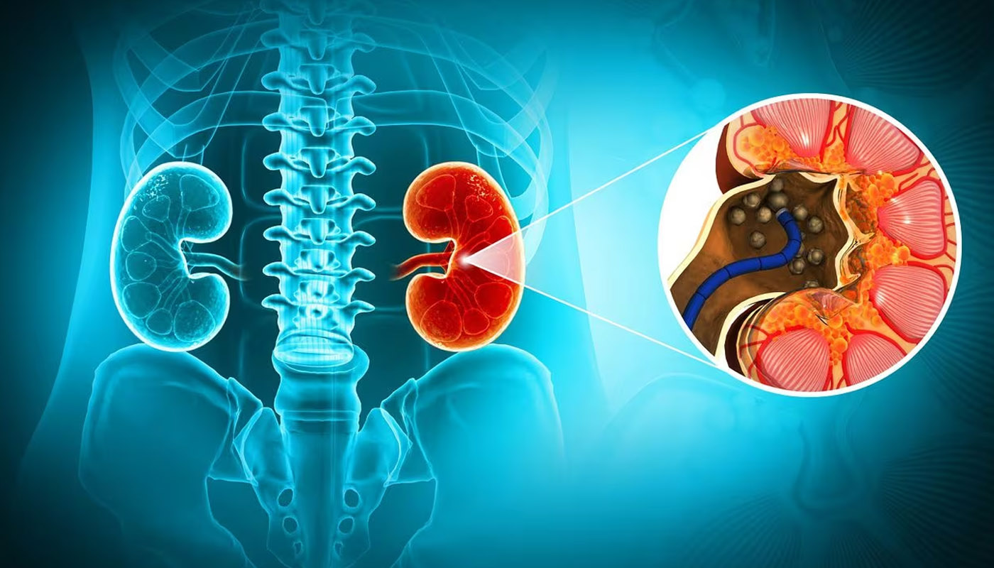 Piedras en el Riñon