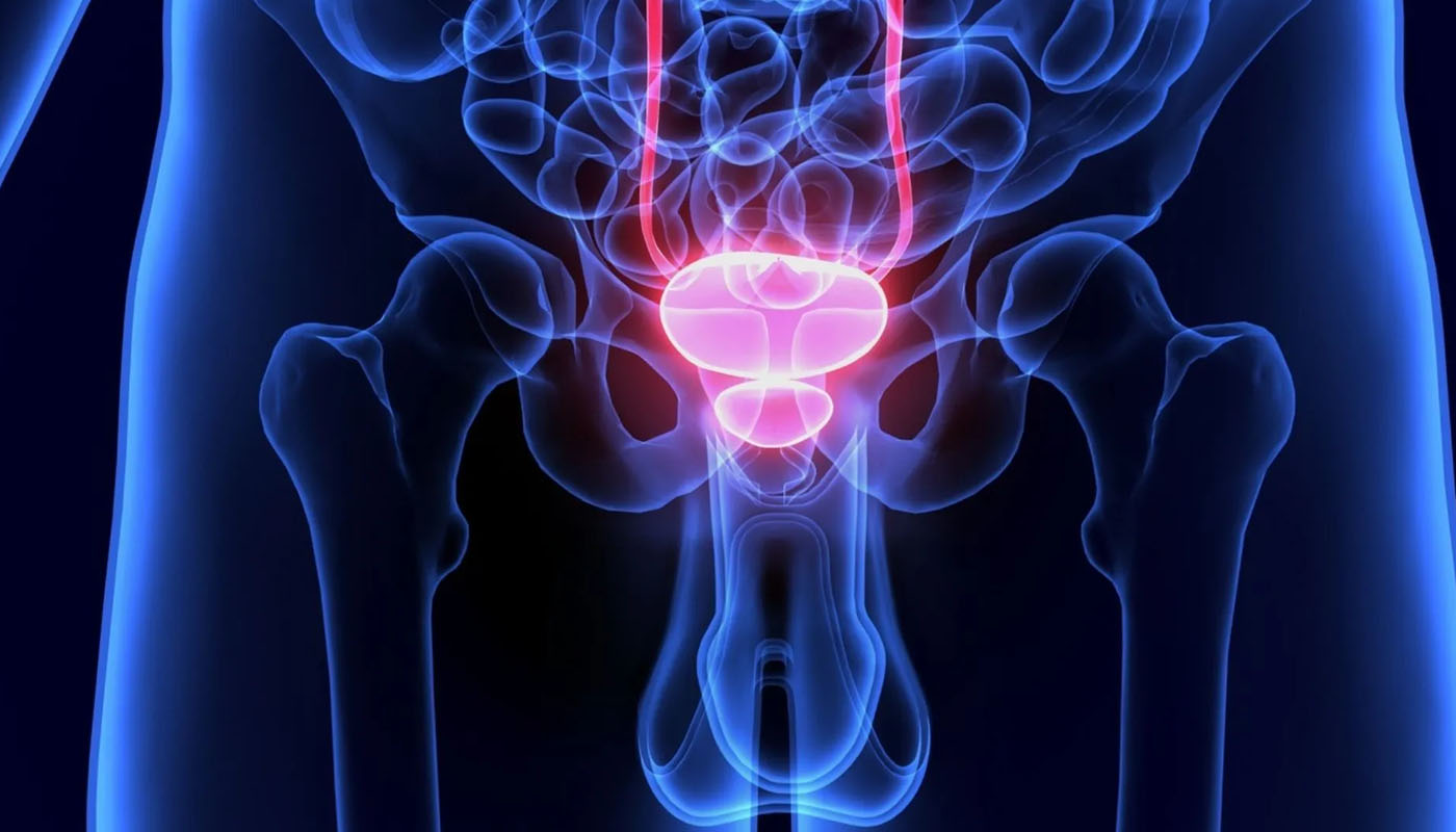 Cirugía de Láser de Próstata